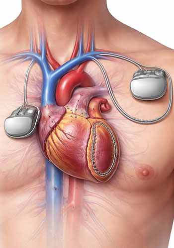Pacemaker & ICD Implantation